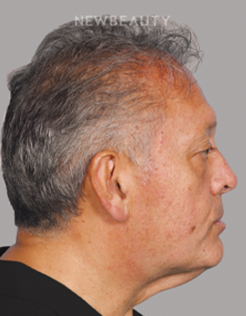 Dr. Mahabir - Traditional Facelift - 20637920 - Before