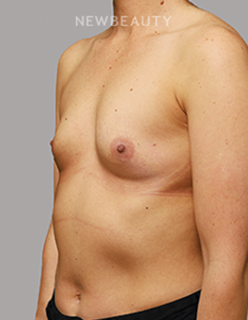 Dr. Kevin Rose - Breast Aug - 44290750 - Before