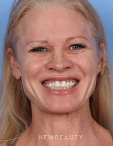 Dr. Kelly Bomer - Botox - Before