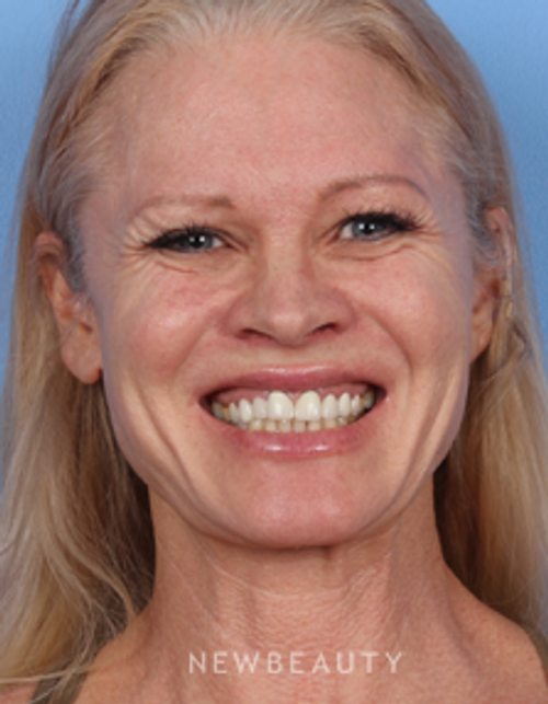 Dr. Kelly Bomer - Botox - Before