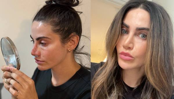 Taryn's rhinoplasty