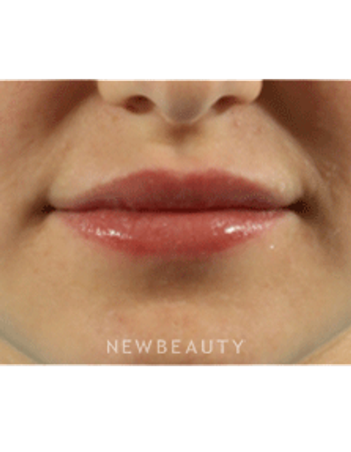 Dr. Marina Peredo Lip Augmentation - After