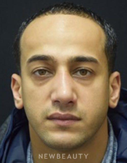 Dr. Jeffrey B. Wise - Rhinoplasty - After