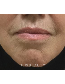 Dr. Julie Russak - Juvéderm Volbella XC - Before