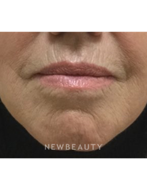 Dr. Julie Russak - Juvéderm Volbella XC - Before
