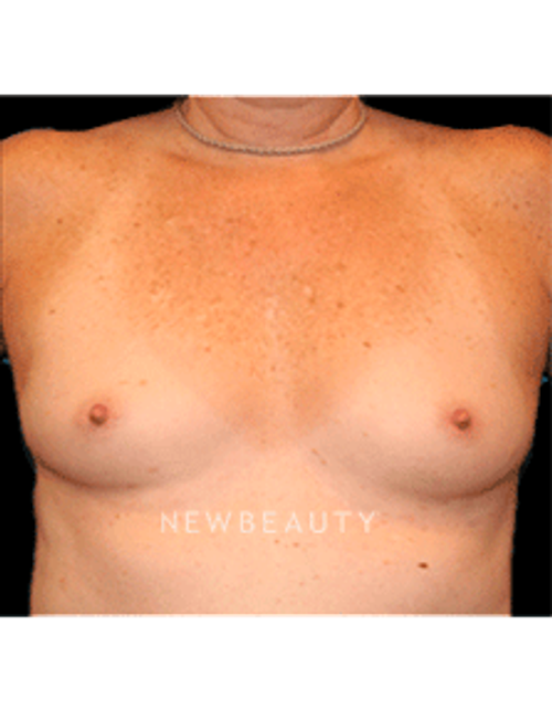 Dr. Christine Hamori Breast Enhancement - Before