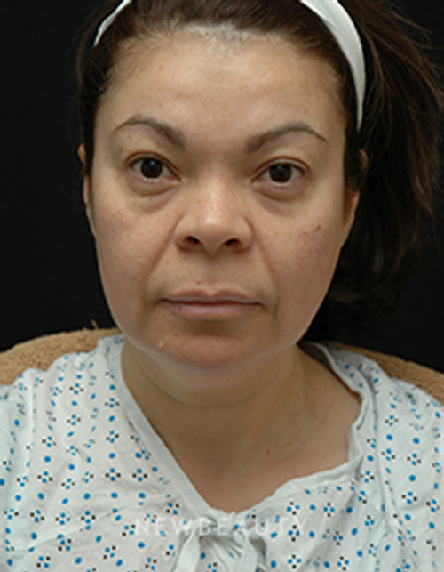 Dr. Jeffrey B. Wise - Eyelift, Facelift, Necklift - Before