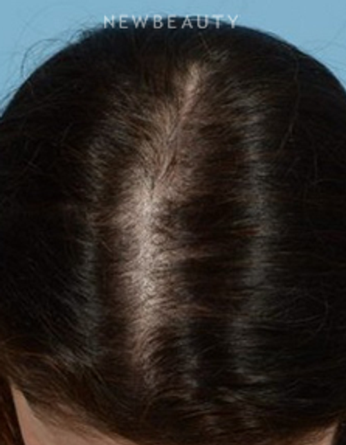 Dr. Jeffrey Wise - Hair-Loss Treatment - Before