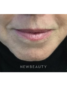 Dr. Julie Russak - Juvéderm Volbella XC - After