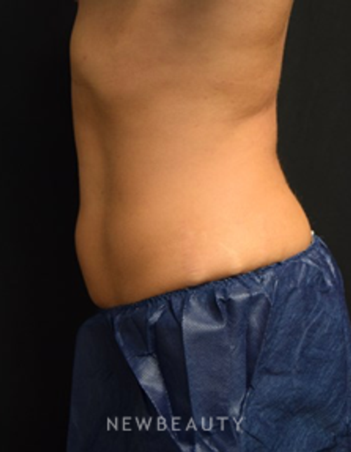 Dr. Jeffrey B. Wise - CoolSculpting - After