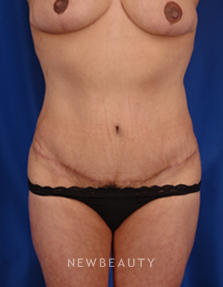 Dr. Peter Geldner Abdominoplasty with Vaser Liposuction - After