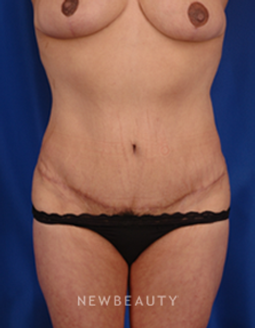 Dr. Peter Geldner Abdominoplasty with Vaser Liposuction - After