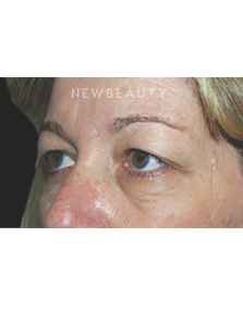 Dr. Roman Rayham - Natural-Looking Results - Before