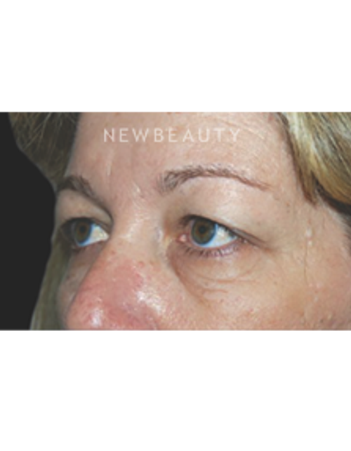 Dr. Roman Rayham - Natural-Looking Results - Before