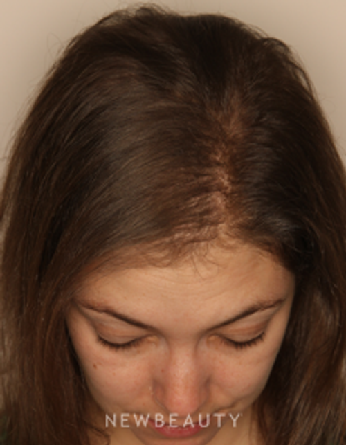 Dr. Doris Day - Hair Loss Treatment - After