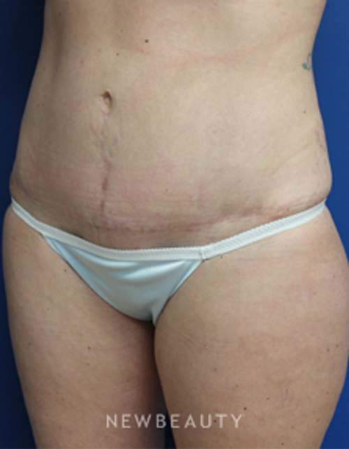 Dr. Joseph Russo - Mommy Makeover - After