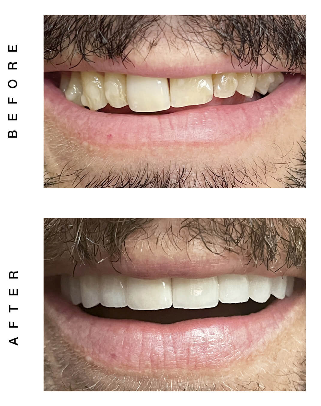 veneers and gum augmentation before and after