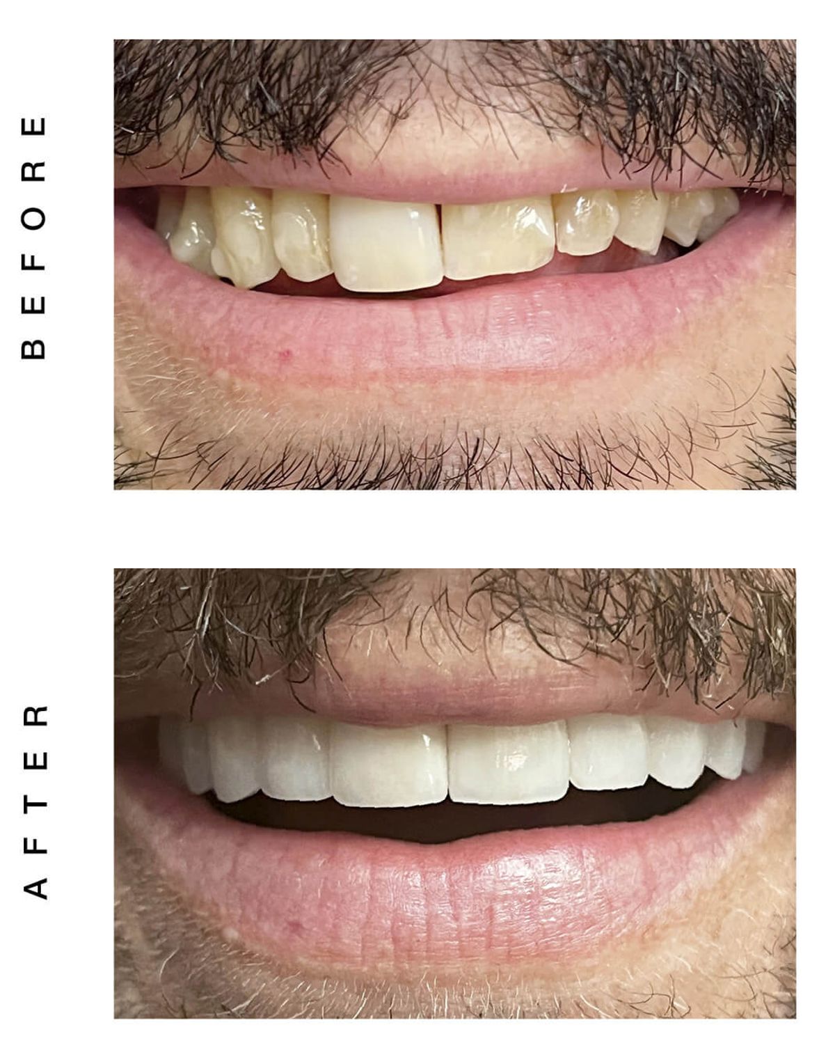 veneers and gum augmentation before and after