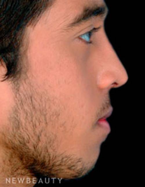Dr. David Kim Rhinoplasty - After