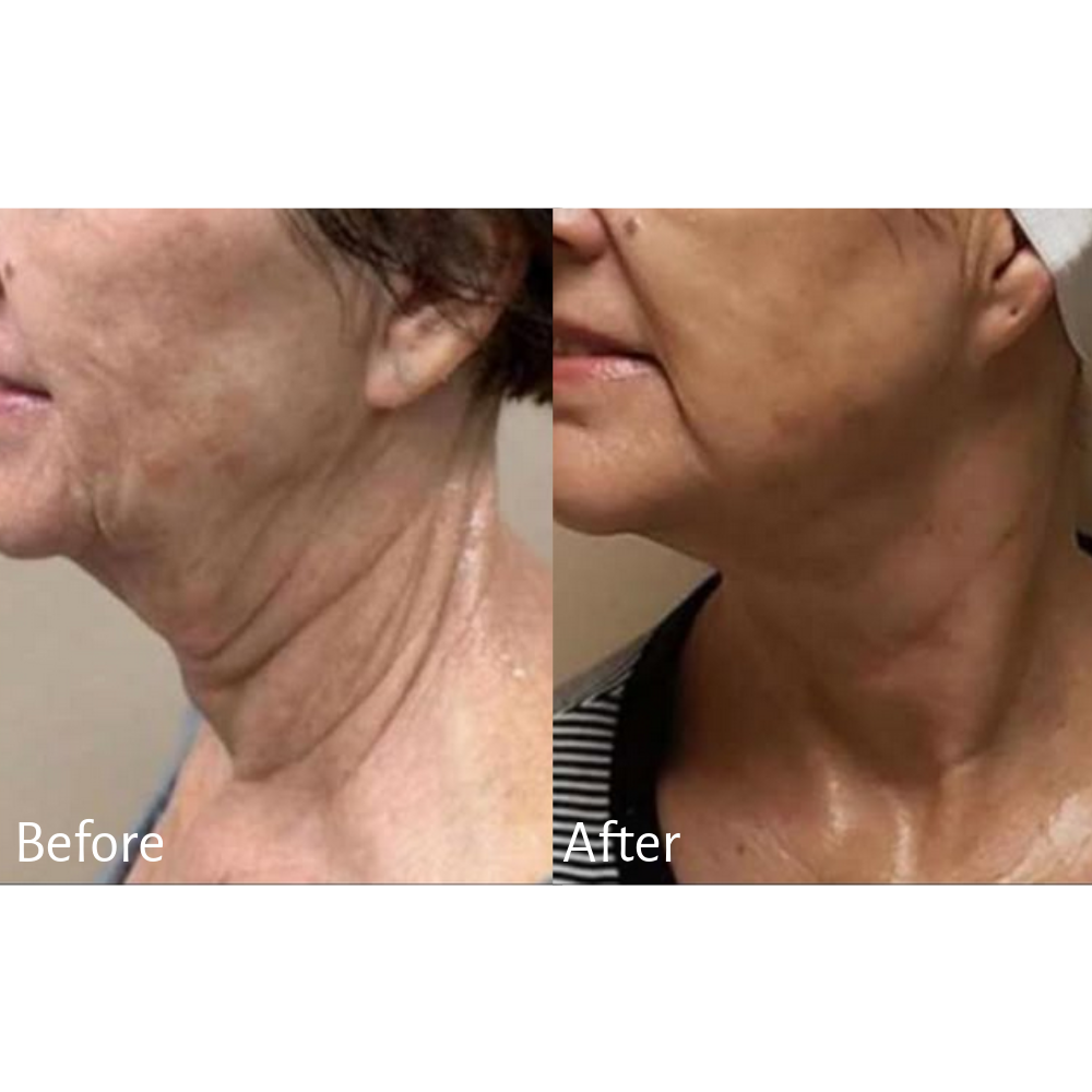 Treatment: Morpheus8 RF