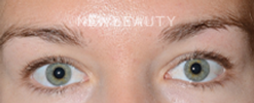 Dr. Jeffrey Epstein - Defined Brows - 44714704 - Before