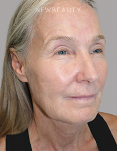 Dr. Sanjay Grover - Facelift - 49726589 - Before