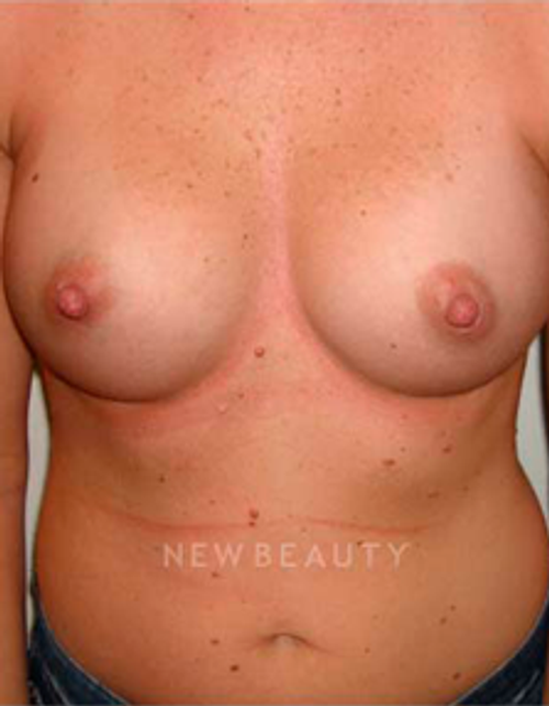 Dr. Michael Horn Silicone Breast Implants - After