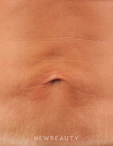 Dr. Ruth Hillelson Skin Tightening, Energy-Based - After