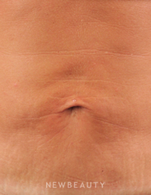 Dr. Ruth Hillelson Skin Tightening, Energy-Based - After