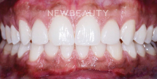Dr. Nathan Hoffman - Invisalign - After