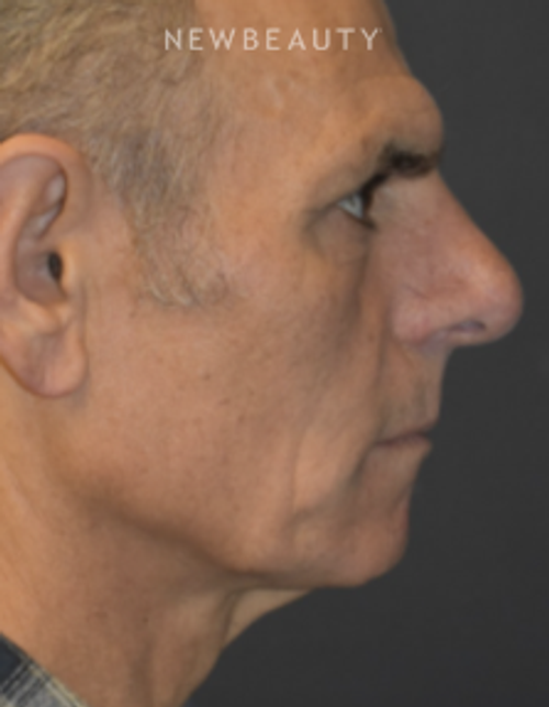 Drs. Lieberman & Parikh - Signature Facelift - Before