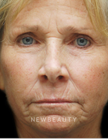 Dr. Kenneth Beer Aesthetic Injectables - Before