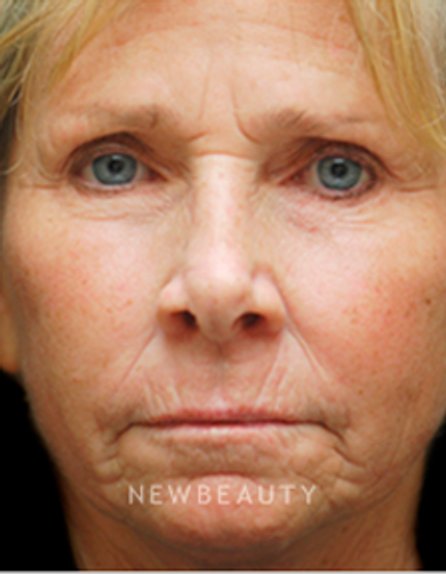 Dr. Kenneth Beer Aesthetic Injectables - Before