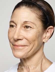 Dr. Ava Shamban - Facial Rejuvenation - Before