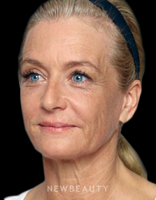 Dr. Kenneth Beer - Liquid Facelift - After