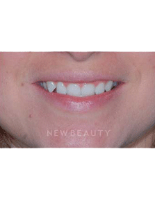 Dr. Guy Lewis Veneers - Before