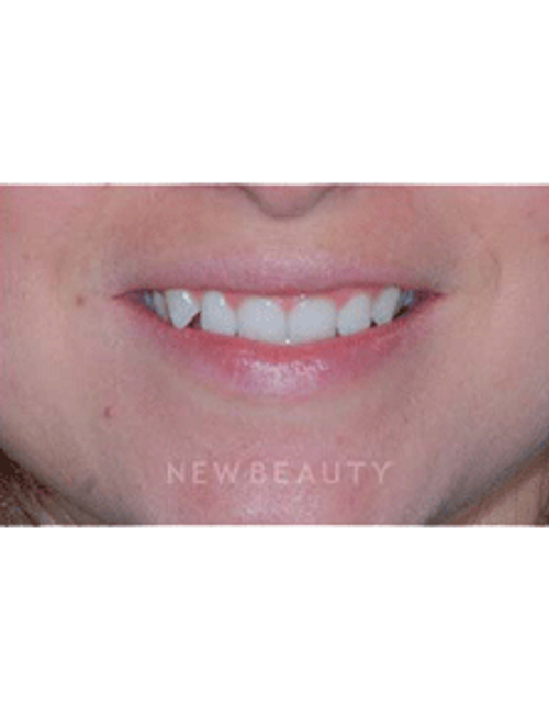 Dr. Guy Lewis Veneers - Before