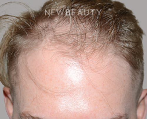 Dr. Jeffrey Epstein - Hair Transplant - 46167913 - Before