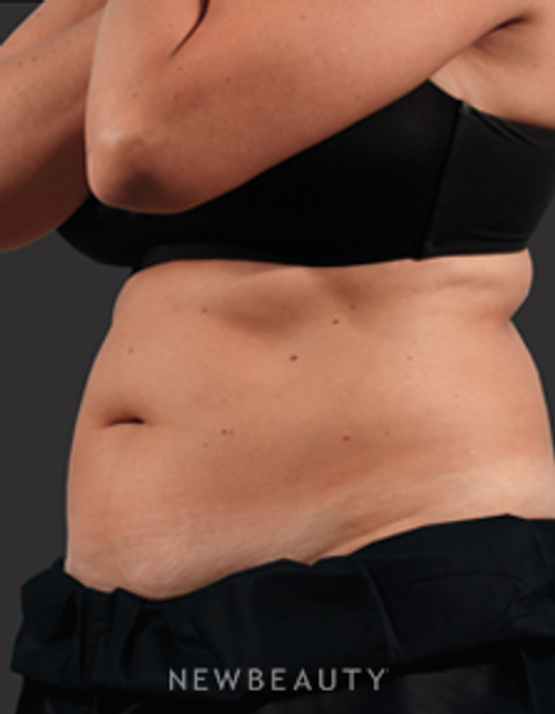 Dr. Marina Peredo Fat Melters - CoolSculpting - Before