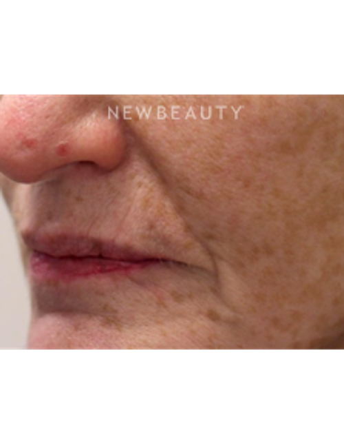Dr. Gilly Munavalli - Lasers - Before