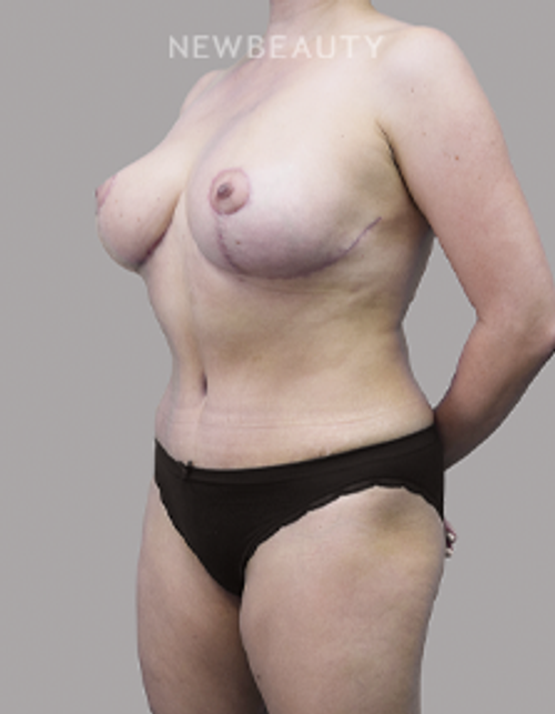 Dr. Olga Bachilo - Mommy Makeover - 28650984 - After