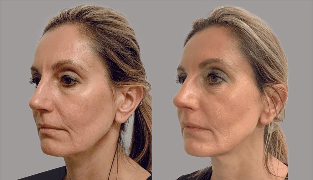 Smoothing + Tightening