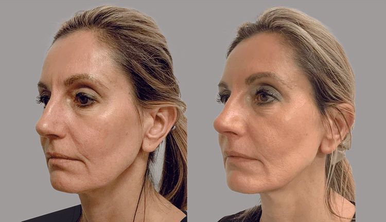 Smoothing + Tightening