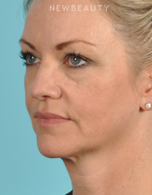 Dr. Bradley Bengtson - Injectables & Fillers - Before
