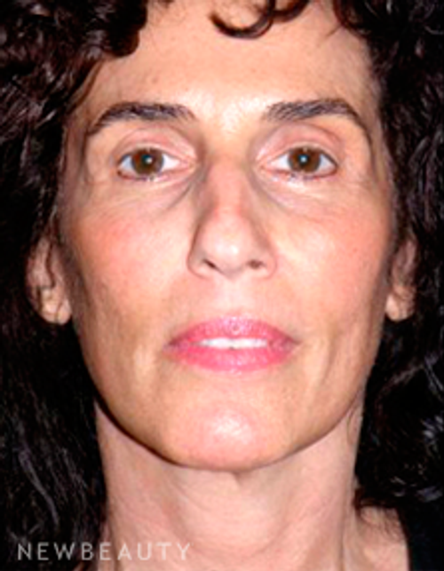 Dr. George Sanders Facelift, Chin Augmentation - After