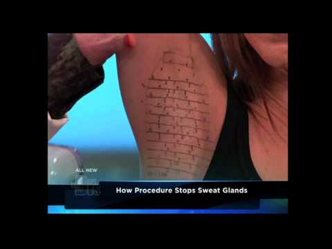 Dr. Shamban – Treating Excess Odor & Sweating With Miradry