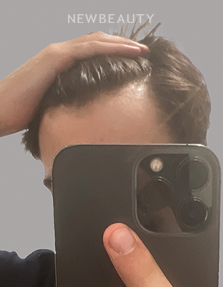 Dr. Anna Chacon - Alopecia - 34279552 - After