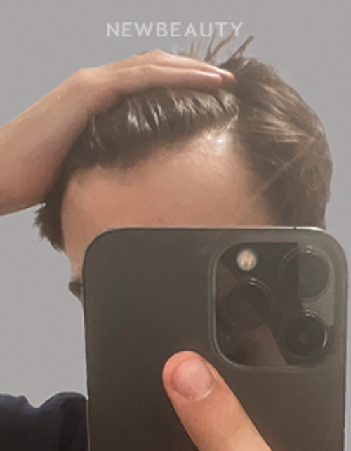 Dr. Anna Chacon - Alopecia - 34279552 - After