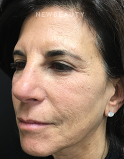 Dr. Mokhtar Asaadi - Blepharoplasties and Kybella - After