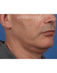 Dr. Julie Russak - Kybella - Before